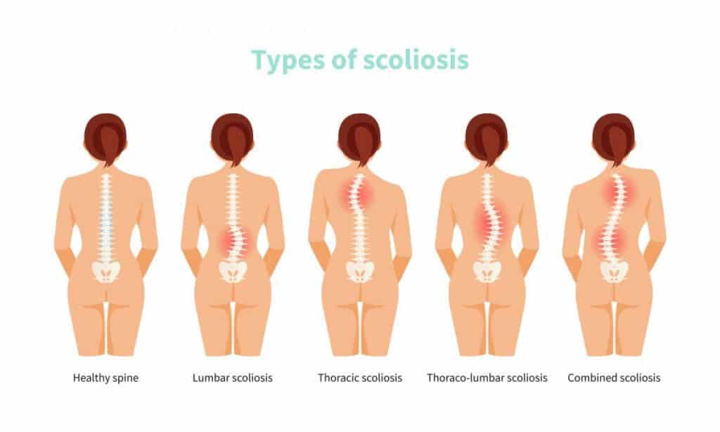 How To Sit In A Chair With Scoliosis Office Solution Pro